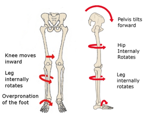Possible effects of flat feet on the rest of the legs